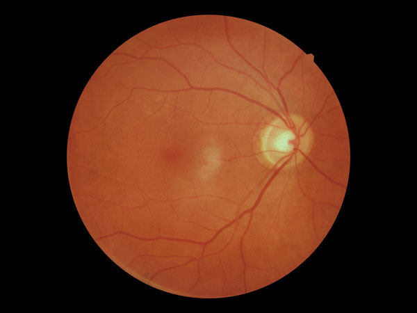 Color fundus image showing the macula and retinal blood vessels